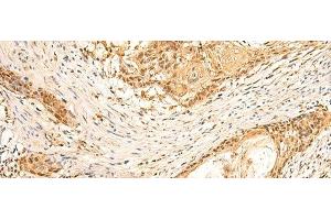 Immunohistochemistry of paraffin-embedded Human esophagus cancer tissue using EEF1AKMT2 Polyclonal Antibody at dilution of 1:50(x200) (METTL10 antibody)