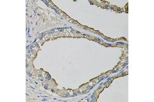Immunohistochemistry of paraffin-embedded human prostate using LCN1 antibody  at dilution of 1:100 (40x lens). (Lipocalin 1 antibody  (AA 19-176))
