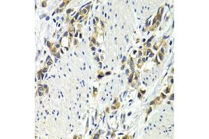 Immunohistochemistry of paraffin-embedded human gastric cancer using WNT3A antibody.