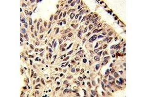 IHC analysis of FFPE human lung carcinoma stained with H4 antibody (HIST1H4A antibody  (meLys20))