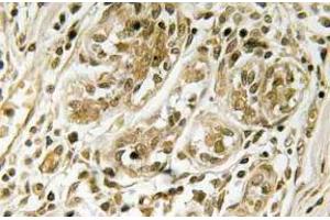 Immunohistochemistry (IHC) analyzes of p-IRS-1 antibody in paraffin-embedded human breast carcinoma tissue. (IRS1 antibody  (pSer639))