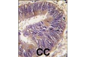 Formalin-fixed and paraffin-embedded human colon carcinoma tissue reacted with ST13 antibody (N-term), which was peroxidase-conjugated to the secondary antibody, followed by DAB staining. (HSC70 Interacting Protein HIP antibody  (AA 50-80))