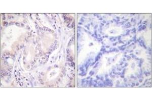 Immunohistochemistry analysis of paraffin-embedded human lung carcinoma, using CDC6 (Phospho-Ser54) Antibody. (CDC6 antibody  (pSer54))