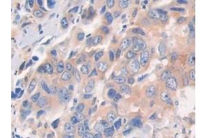 Detection of CECR1 in Human Breast cancer Tissue using Polyclonal Antibody to Cat Eye Syndrome Chromosome Region, Candidate 1 (CECR1) (CECR1 antibody  (AA 30-511))