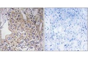 Immunohistochemistry analysis of paraffin-embedded human breast carcinoma tissue, using TNXB Antibody. (TNXB antibody  (AA 1761-1810))