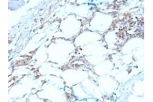 Formalin-fixed, paraffin-embedded human Mesothelioma stained with Calretinin Mouse Monoclonal Antibody (CALB2/2603).
