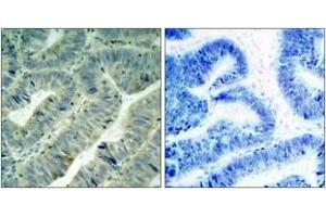 Immunohistochemistry analysis of paraffin-embedded human colon carcinoma, using Src (Phospho-Tyr418) Antibody. (Src antibody  (pTyr419))