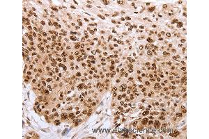 Immunohistochemistry of Human esophagus cancer using PARP1 Polyclonal Antibody at dilution of 1:40 (PARP1 antibody)
