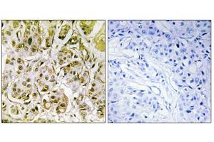 Immunohistochemistry analysis of paraffin-embedded human breast carcinoma tissue, using Smad1 (Phospho-Ser187) antibody. (SMAD1 antibody  (pSer187))