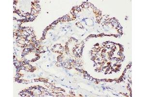 IHC-P: Peroxiredoxin 5 antibody testing of human prostatic cancer tissue