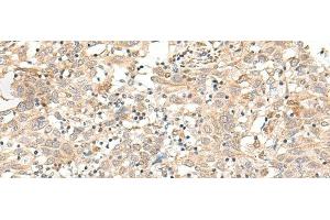 Immunohistochemistry of paraffin-embedded Human cervical cancer tissue using FUT3 Polyclonal Antibody at dilution of 1:35(x200) (FUT3 antibody)