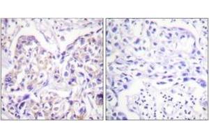Immunohistochemistry analysis of paraffin-embedded human breast carcinoma tissue, using IRS-1 (Ab-323) Antibody. (IRS1 antibody  (AA 289-338))
