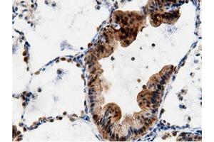 Immunohistochemical staining of paraffin-embedded Adenocarcinoma of Human breast tissue using anti-AK5 mouse monoclonal antibody. (Adenylate Kinase 5 antibody)