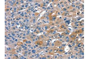 The image on the left is immunohistochemistry of paraffin-embedded Human liver cancer tissue using ABIN7130906(RNF7 Antibody) at dilution 1/20, on the right is treated with fusion protein. (RNF7 antibody)