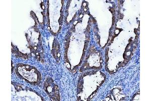 IHC analysis of TRK fused gene/TFG using anti-TRK fused gene/TFG antibody (ABIN7599839). (TFG antibody  (AA 121-400))