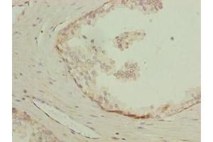 Immunohistochemistry of paraffin-embedded human prostate cancer using ABIN7158732 at dilution of 1:100 (LYSMD1 antibody  (AA 1-227))