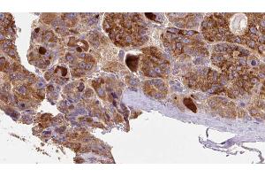 ABIN6273892 at 1/100 staining Human liver cancer tissue by IHC-P. (GPR77 antibody  (C-Term))