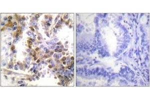 Immunohistochemistry analysis of paraffin-embedded human lung carcinoma tissue, using 4E-BP1 (Ab-36) Antibody.