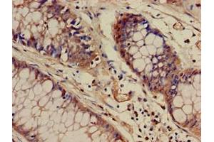 Immunohistochemistry of paraffin-embedded human colon cancer using ABIN7175830 at dilution of 1:100 (WASF1 antibody  (AA 381-553))