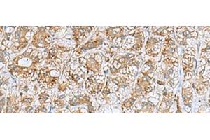 Immunohistochemistry of paraffin-embedded Human liver cancer tissue using NQO2 Polyclonal Antibody at dilution of 1:70(x200) (NQO2 antibody)