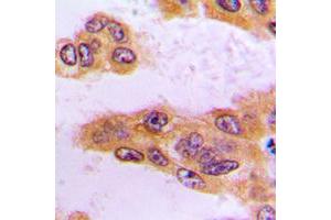 Immunohistochemical analysis of BCKDK staining in human liver cancer formalin fixed paraffin embedded tissue section. (BCKDK antibody  (N-Term))