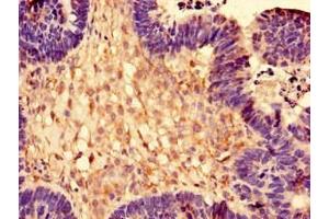 Immunohistochemistry of paraffin-embedded human ovarian cancer using ABIN7142792 at dilution of 1:100 (RPL28 antibody  (AA 2-137))