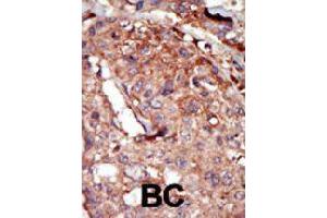 Formalin-fixed and paraffin-embedded human cancer tissue reacted with BRD2 polyclonal antibody  , which was peroxidase-conjugated to the secondary antibody, followed by AEC staining. (BRD2 antibody  (Internal Region))