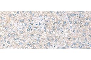 Immunohistochemistry of paraffin-embedded Human liver cancer tissue using FARP2 Polyclonal Antibody at dilution of 1:70(x200) (FARP2 antibody)