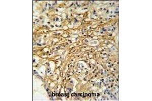 DC13 Antibody (N-term) (ABIN651108 and ABIN2840074) IHC analysis in formalin fixed and paraffin embedded human breast carcinoma followed by peroxidase conjugation of the secondary antibody and DAB staining. (C16orf61 antibody  (N-Term))