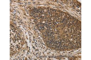 Immunohistochemistry of Human colon cancer using DACH1 Polyclonal Antibody at dilution of 1:50 (DACH1 antibody)