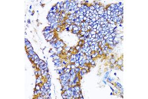 Immunohistochemistry of paraffin-embedded human colon carcinoma using MRPL13 antibody  at dilution of 1:100 (40x lens). (MRPL13 antibody  (AA 1-179))