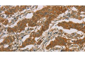 Immunohistochemistry of paraffin-embedded Human gasrtic cancer tissue using CYP39A1 Polyclonal Antibody at dilution 1:50 (CYP39A1 antibody)
