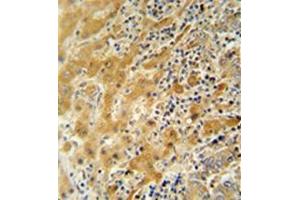 Immunohistochemistry analysis in formalin fixed and paraffin embedded human hepatocarcinoma reacted with NUSAP1 / ANKT Antibody (N-term) followed by peroxidase conjugation of the secondary antibody and DAB staining. (NUSAP1 antibody  (N-Term))