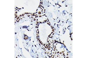 Immunohistochemistry of paraffin-embedded human breast cancer using HDGF Rabbit pAb  at dilution of 1:50 (40x lens). (HDGF antibody  (AA 1-240))