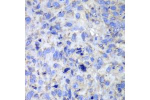 Immunohistochemistry of paraffin-embedded human lung cancer using CASP7 antibody (ABIN5970716) at dilution of 1/100 (40x lens). (Caspase 7 antibody)