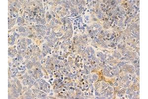 ABIN6265724 and ABIN6266700 at 1/100 staining human thymoma by IHC-P.