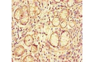 Immunohistochemistry of paraffin-embedded human gastric cancer using ABIN7144126 at dilution of 1:100 (ACE2 antibody  (AA 395-638))