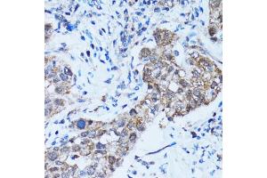 Immunohistochemistry of paraffin-embedded human lung cancer using CASP3 antibody (ABIN5997372) at dilution of 1/100 (40x lens). (Caspase 3 antibody)