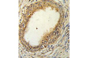 HLN1 Antibody (N-term) 9791a IHC analysis in formalin fixed and paraffin embedded prostate carcinoma followed by peroxidase conjugation of the secondary antibody and DAB staining. (HAPLN1 antibody  (N-Term))