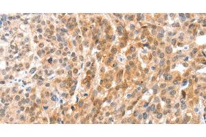 Immunohistochemistry of paraffin-embedded Human esophagus cancer using ANXA8 Polyclonal Antibody at dilution of 1:35 (Annexin VIII antibody)