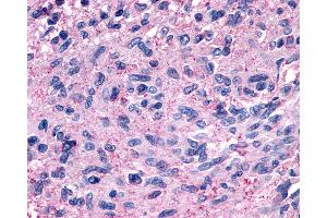 Anti-GPR139 antibody IHC of human Brain, Glioblastoma. (GPR139 antibody  (Cytoplasmic Domain))