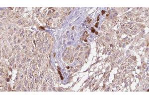 ABIN6274983 at 1/100 staining Human Melanoma tissue by IHC-P. (CGREF1 antibody  (C-Term))