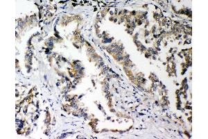 Anti-PLK2 antibody, IHC(P) IHC(P): Human Lung Cancer Tissue (PLK2 antibody  (C-Term))
