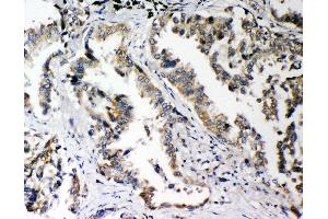 Anti-PLK2 antibody, IHC(P) IHC(P): Human Lung Cancer Tissue