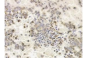 ABIN6263761 and ABIN6278213 at 1/100 staining human melanoma by IHC-P.