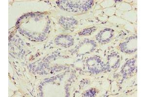 Immunohistochemistry of paraffin-embedded human breast cancer using ABIN7174434 at dilution of 1:100 (UBE2D1 antibody  (AA 1-147))