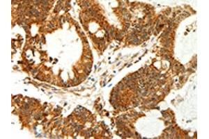 The image on the left is immunohistochemistry of paraffin-embedded Human colon cancer tissue using ABIN7129018(COX7B Antibody) at dilution 1/60, on the right is treated with fusion protein. (COX7B antibody)
