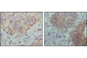 Immunohistochemical analysis of paraffin-embedded human lung cancer (left) and colon cancer (right) showing cytoplasmic localization with DAB staining using EphB1 mouse mAb.