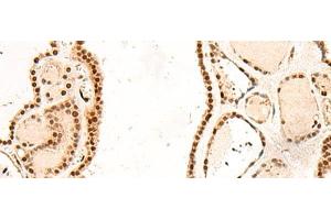 Immunohistochemistry of paraffin-embedded Human thyroid cancer tissue using RMND5B Polyclonal Antibody at dilution of 1:50(x200) (RMND5B antibody)