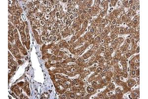 IHC-P Image BMPR1B antibody [N3C3] detects BMPR1B protein at cytosol on human hepatoma by immunohistochemical analysis. (BMPR1B antibody)